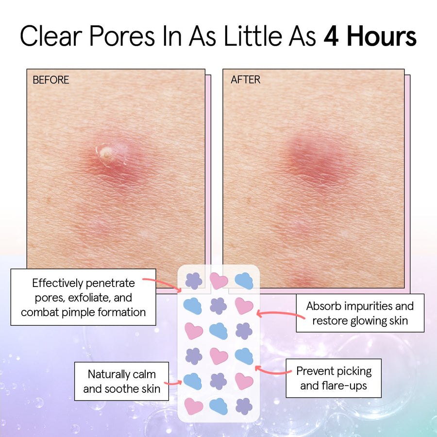 Comparison of skin pores before and after treatment, highlighting the effectiveness of grace & stella's hydrocolloid pimple patches in reducing pores and improving skin texture.