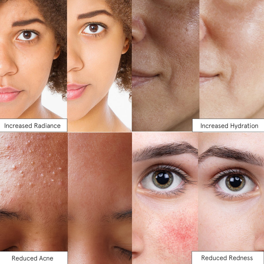 A composite image showing before and after results for various skin treatments: increased radiance, increased hydration, reduced acne, and reduced redness thanks to grace & stella's rose spray.